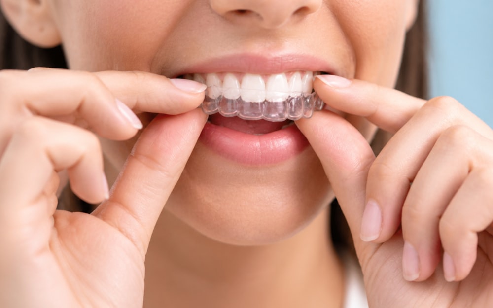 Woman fitting a clear orthodontic aligner