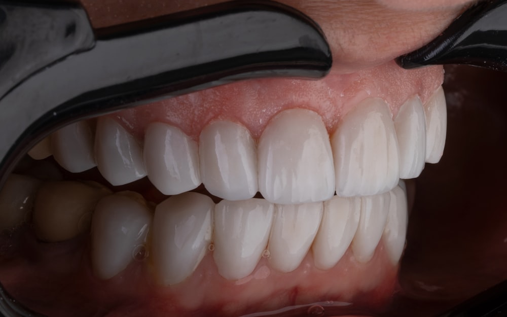 Close-up of front teeth after composite bonding