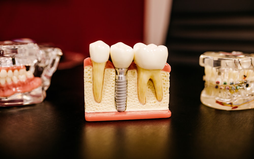 Dental implant model showing the fixture in the jawbone