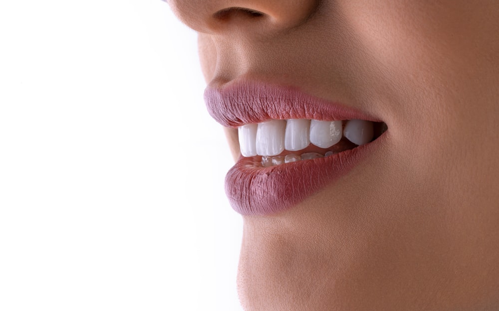 Close-up of a smile with porcelain veneers